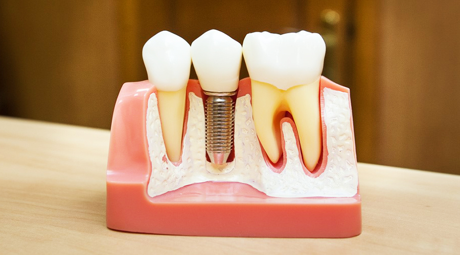Имплантация зубов и остеопластика